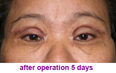 plastic-surgery-blepharoplasty